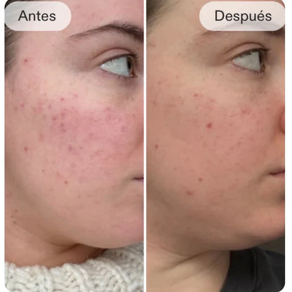 SkinGlow - Mascara LED + Vitamina C            ¡La revolución del cuidado facial en casa!
